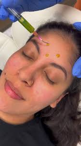 BioRePeel is the no downtime, no-fluff, results-driven treatment your skin  has been waiting for., Brightens. Tightens. Clears. Smooths., All in one  protocol., Call to book 727-610-5335, ...