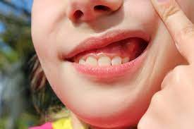 Bulto En La Encia Que Puede Ser Clinica Dental Soria Vizcaino
