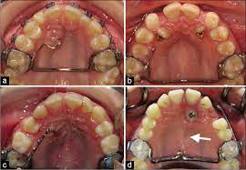 The postoperative recovery was longer after open eruption than close eruption technique (p = 0.000). Orthodontic Management Of Impacted Maxillary Canines Apos Trends In Orthodontics