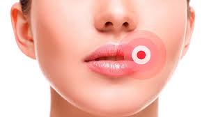 заеды в уголках рта причины и лечение у взрослых V Ugolkah U Rta Bolit Znachit Eto Angulit Novosti I Stati V Regione Moskovskij Region Aptekamos