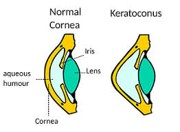 Astigmatism is an common eye condition that causes blurred vision as the result of an incorrectly curved cornea. The Ultimate Guide To Astigmatism Feel Good Contacts Uk