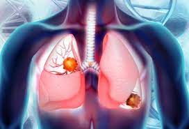Every year, there are nearly 3,000 people diagnosed with cancer. What Is The Main Cause Of Mesothelioma