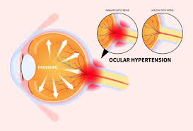 Image result for Intraocular Pressure