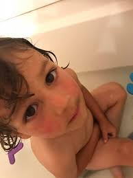 What do you think about baths in natural sodium–iodide–bromide brine? Son  4yo, eb simplex