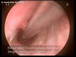 Maybe you would like to learn more about one of these? Tanpa Irisan Belakang Telinga Operasi Gendang Telinga Endoskopi Endoscopic Inlay Tympanoplasty Youtube