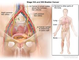 1 other common symptoms are frequent, urgent, or painful urination. Bladder Cancer Hematology Oncology Associates Of Cny