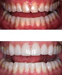 But first, consider the cost for just a single porcelain dental veneer that can run well over $500. Porcelain Veneers Are The Wrong Color Again Steven Brooksher Dds