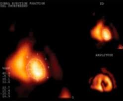 Image result for Nuclear Ventriculogram