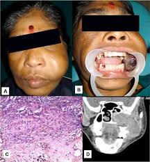 The patient presents with a problem of the left jaw. Fibroblastic Variant Of Osteosarcoma A Challenge In Diagnosis Management Fulltext