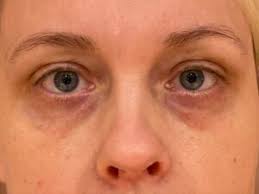 Image result for xantelasma