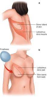 Generally, the patients present for treatment of the chest deformity and breast asymmetry. Poland S Syndrome Springerlink