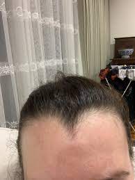 Do I Have An Abnormally Large Widows Peak For A Woman Shout Out To My Widows Peak Friends H Widow S Peak Widows Peak Hairstyles Widow S Peak Hairstyles Women