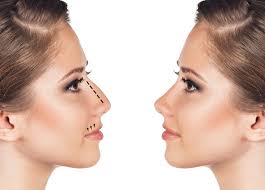 Vereinbaren sie mit diesem bekannten plastischen chirurgen aus beverly hills babak azizzade. Nasenkorrektur Rhinoplastik Dr Alexander Kozlowski