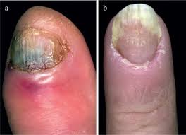 Image result for paronychium