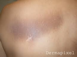 Dermapixel Una Mancha En La Espalda