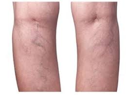 La trombosis venosa es la tercera causa de muerte cardiovascular después del infarto agudo de miocardio y el ictus. Como Prevenir La Trombosis Venosa En Los Adultos Mayores Salud Y Longevidad