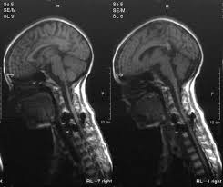 The aneurysmal bone cyst (abc; Aneurysmal Bone Cyst Of The Cervical Spine In A Child Case Report And Review Of The Surgical Role Sciencedirect