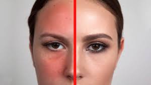Daily essentials sensitive day cream effectively reduces the 3 main signs of sensitive skin; 15 Helpful Tips To Reduce Redness On Your Face Quickly