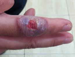 Eschar is the formation of thick, tight damaged tissue followed by loosing of the damaged tissue from the healthy tissue with daily debridement, the use of enzymes, or surgery. Anthrax Dermnet Nz