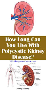 Kidney Stones Watches Polycystic Kidney Disease Kidney Disease Chronic Kidney Disease