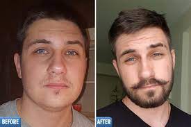 You may wash it off after 4 hours, or just leave it on as it will dry and absorb into your skin. Beardless Men Are Rubbing Hair Loss Drug On Their Face For Fuller Fuzz But Experts Warn It Could Fall Out