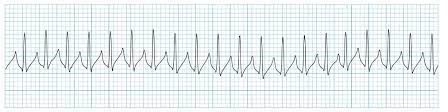 176 meanings for svt abbreviations and acronyms on acronymsandslang.com the world's most comprehensive acronyms and slang. Supraventricular Tachycardia Svt Litfl Ecg Library Diagnosis