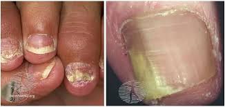 Image result for Pitting nails feet