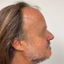 Fort Lauderdale Hair Transplants & Restoration