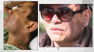 Acid attack victim speaks with FOX6 News