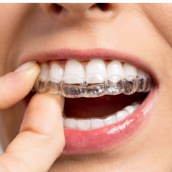 Clear Aligners Treatment in Pashan, Pune product image