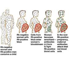 Image result for Rh Sensitization