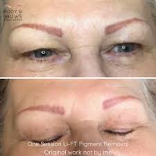 Check out best advisable methods to remove permanent tattoo at home or by laser treatment. Remove Or Correct Body And Brows By Alice Kingdom