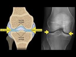 Image result for Knee XRay
