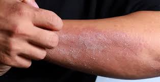 Image result for Anaphylaxis