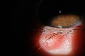 Medicul oftalmolog monica pop , recomandă un tratament de creștere a imunității generale, mai ales. Cosurile Sau UmflÄturile De Pe Pleoape Nu Sunt De Neglijat Happymed Tv