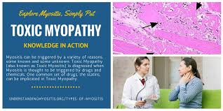 Image result for Myopathy