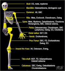 Pain is the most common sign of bone cancer, and may become more noticeable as the tumor grows. The Radiology Assistant Differential Diagnosis Of Bone Tumors