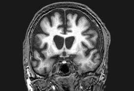 Protein deposits, called lewy bodies, develop in nerve cells in the brain regions involved in thinking, memory and movement (motor control). Vascular Multi Infarct Dementia Picture Image On Medicinenet Com
