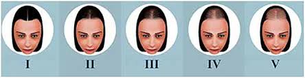 I know that strands of hair can be broken off/pulled out during a dermaroller session…but can it cause temporary shedding? Female Pattern Hair Loss A Clinical Pathophysiologic And Therapeutic Review Sciencedirect