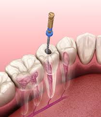 Once the tooth has been root canal treated, it generally has to go for a crown on top of it. Root Canals Lakewood Ranch Fl Save A Severely Damaged Tooth