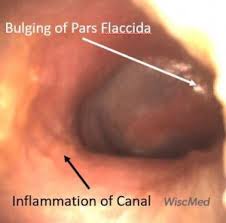 Image result for Acute Otitis Externa