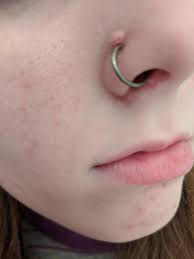 Tragus Piercing How To Get Rid Of Bumps Around Nose Piercing What To Put On  A