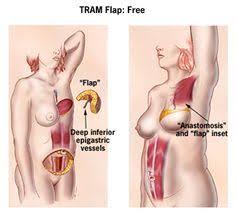 Pin On Breast Reconstruction Information