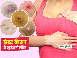 Breast cancer symptoms in hindi. 6 Early Symptoms Of Breast Cancer In Women Other Than Lumps In Hindi à¤¸ à¤° à¤« à¤— à¤  à¤¨à¤¹ à¤¯ 6 à¤¸ à¤• à¤¤ à¤­ à¤¹ à¤¸à¤•à¤¤ à¤¹ à¤¸ à¤¤à¤¨ à¤• à¤¸à¤° à¤¬ à¤° à¤¸ à¤Ÿ à¤• à¤¸à¤° à¤• à¤¸ à¤• à¤¤ à¤œ à¤¨ à¤• à¤¸ à¤ªà¤¹à¤š à¤¨