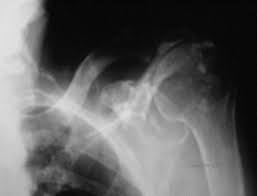 Image result for XRay Changes in Rheumatic Conditions