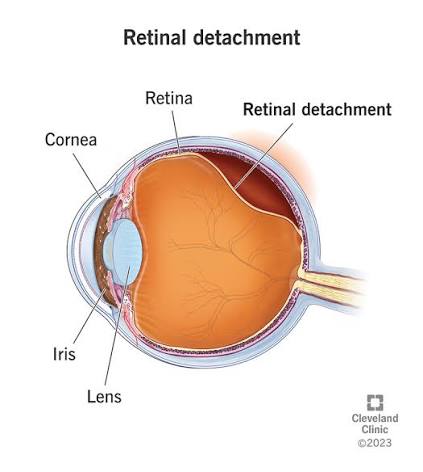 Retinal Detachment: Symptoms, Causes, and Treatment