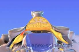 Check spelling or type a new query. Herniated Disc Apex Spine 2021