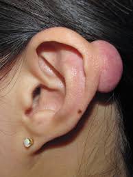 Image result for Keloid