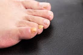 Image result for Yellow nail syndrome feet