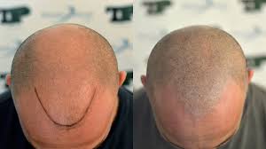 Di dover smettere le cure volta eseguita la micro pigmentazione. Tricopigmentazione La Tecnica Calvizie Net